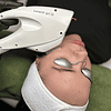 ipl facial 00