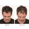 Hair treatment before and after comparison, 3 months