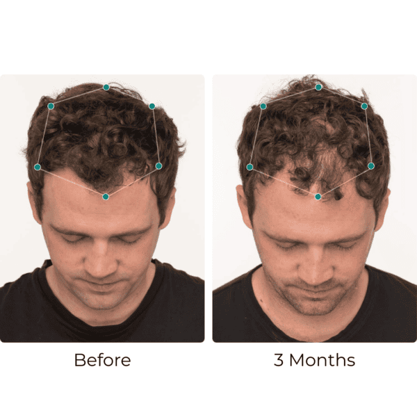 Hair treatment before and after comparison, 3 months