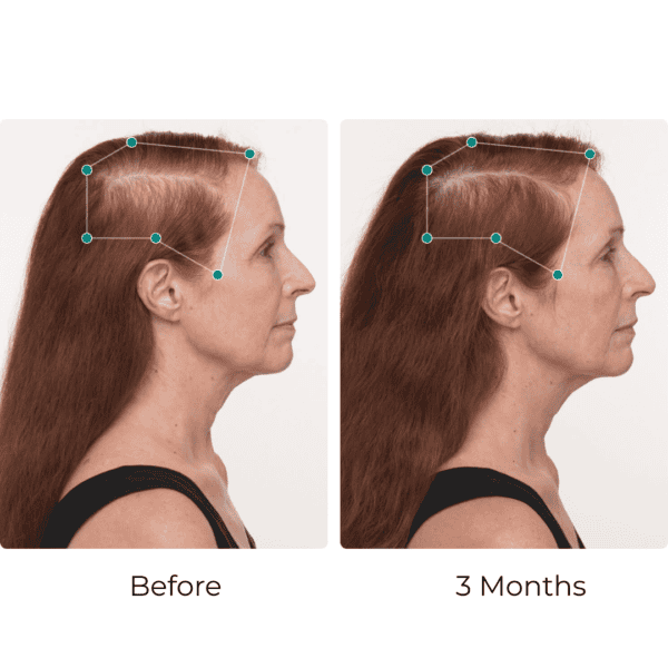 Hair growth comparison before and after three months.