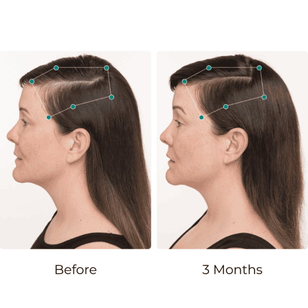 Hair growth progress over three months comparison